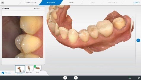 Scan of lower jaw, with prepared tooth 37