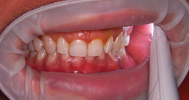 Ipersensibilità dentinale
