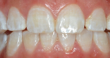 La Microabrasión en Odontología Estética
