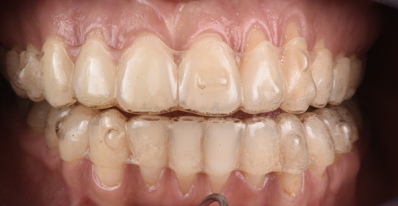 Fig 9 - Allineatori trasparenti in posizione al termine del trattamento.