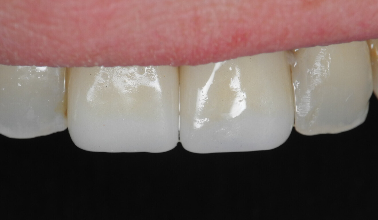 Fig. 9: Crowns immediately after placement. 