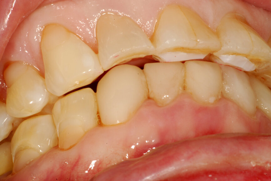 Fig. 7: Composite resin device creating a disclusion of posterior teeth.