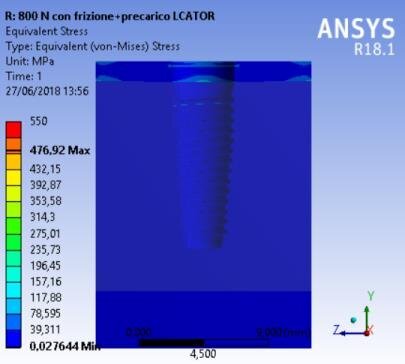 Fig. 10b - Von Mises results referred to the bone at the maximum stress, locator prosthesis.