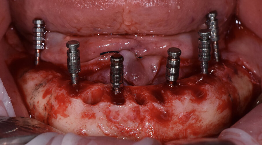 Fig. 7 - Preparazione siti implantari.