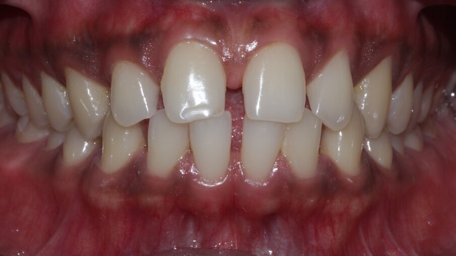 Fig 1: Pre op in occlusion