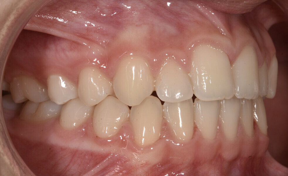 Fig. 6: Facial and intra-oral photographs after treatment with fixed orthodontic appliances.
