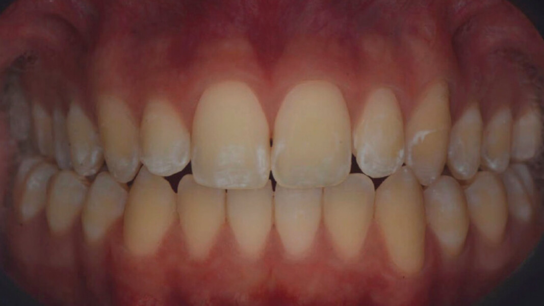 Figg. 9, 10 - Visione polarizzata che evidenzia le white spot lesions.