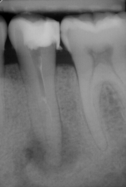 Fig. 5: Radiograph after the first treatment session.