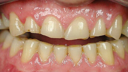 Riabilitazioni full arch con preparazioni microinvasive