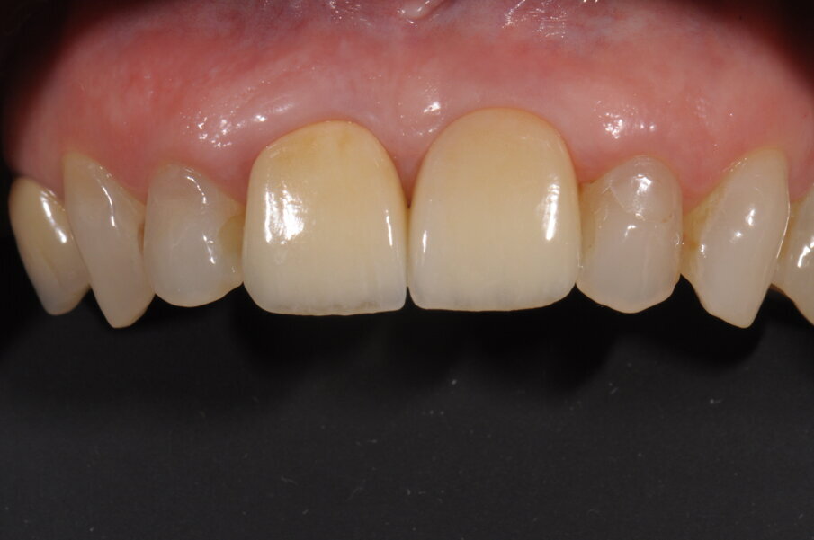 Fig. 15 - Controllo clinico a 5 anni dal posizionamento implantare.
