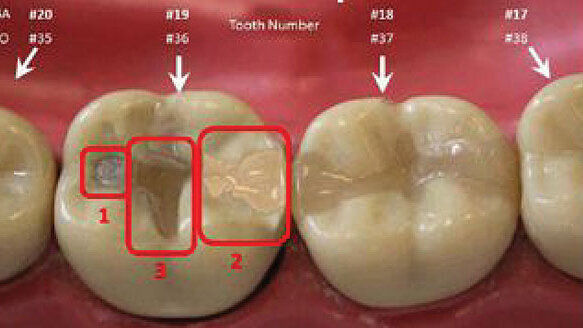 Protocol for forensic dental data now same as for DNA and fingerprinting
