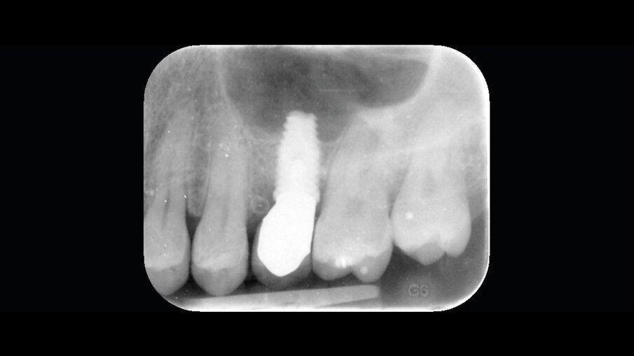 Fig. 9 - Radiografia endorale del sito 2.5 post-trattamento (3 mesi).