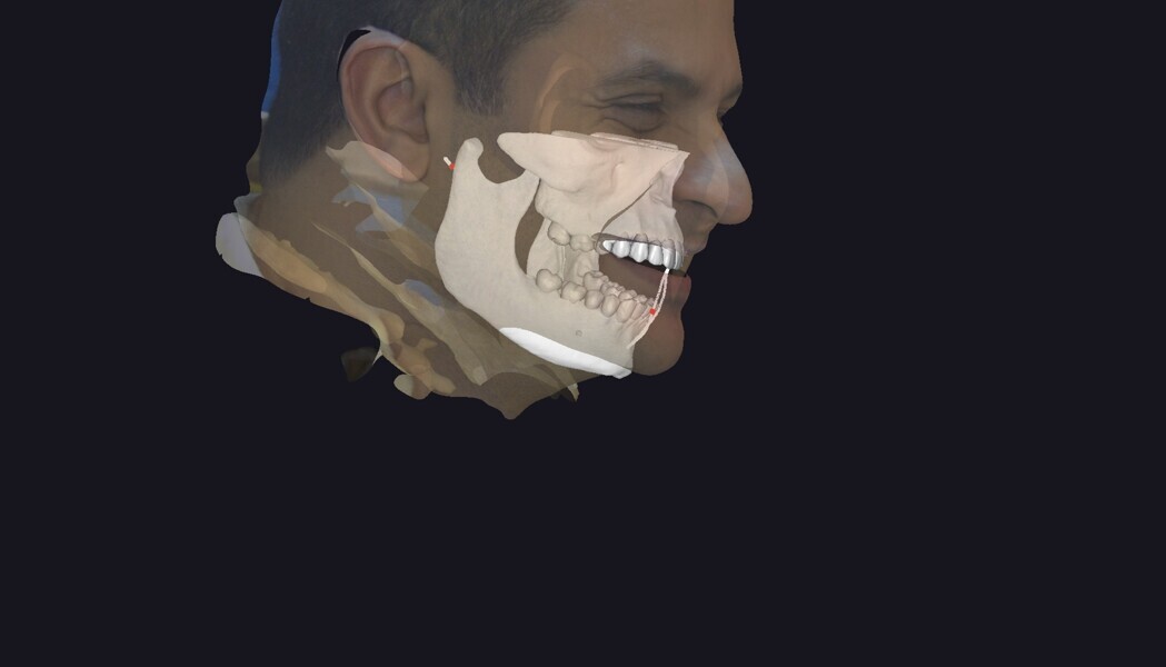 Fig. 5: This lateral profile simulation shows skeletal dynamics with the designed smile in place. It integrated bone reference and jaw movement for prosthetically driven, functionally informed aesthetics.