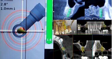 Study shows dynamic navigation superiority in complex maxillary implant cases