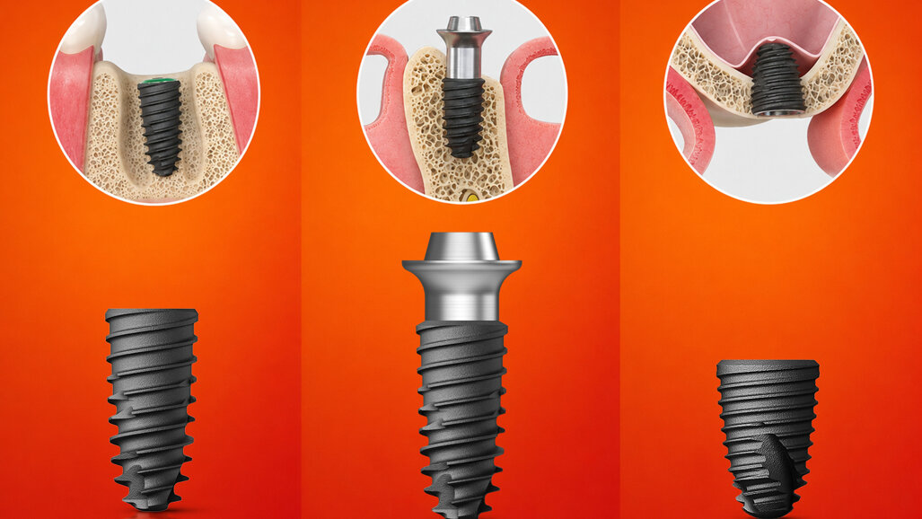 Osstem Implant – New KS implant line