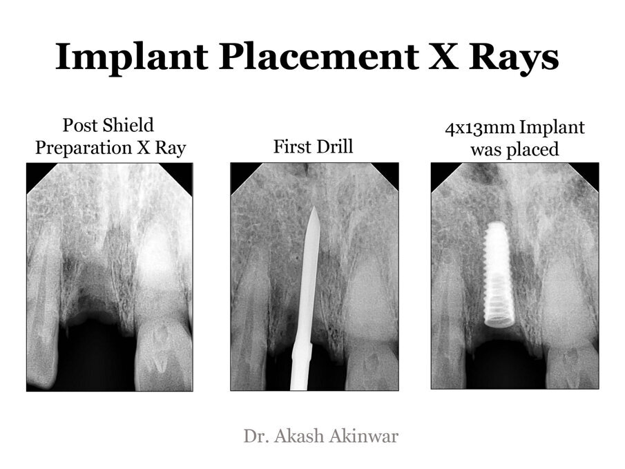 Fig 17: Radiographic documentation of implant placement