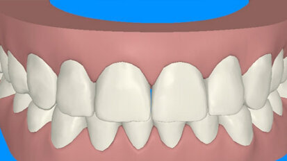 Smile Makeover: Ortodonzia preprotesica finalizzata alla Cosmesi odontoiatrica