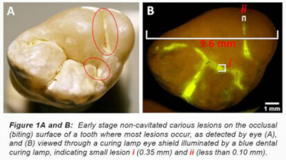 GreenMark to develop technology for early caries detection