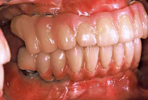 Fig. 8. Temporary restorations retained on the provisional implant abutments.