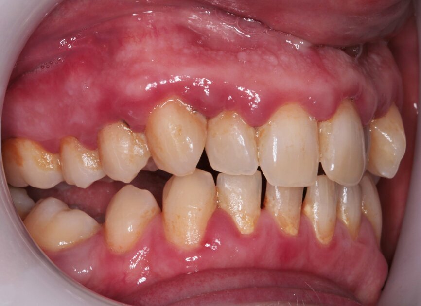Fig. 4: Pre-treatment right lateral