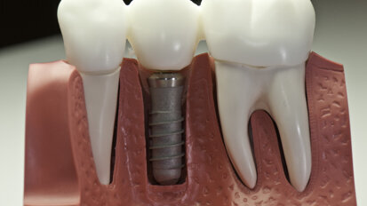 Heeltijd dentale implantaten kan omlaag