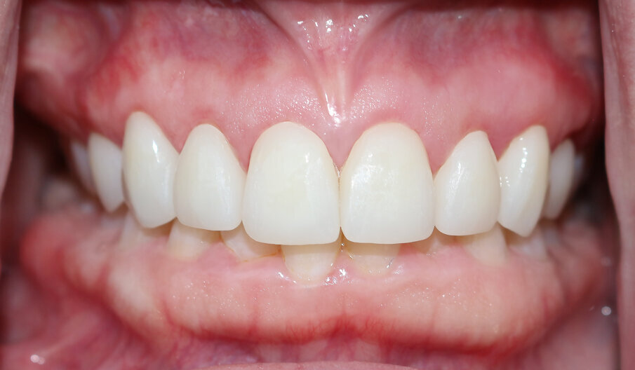 Fig. 4: Veneers placed. 