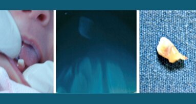 Tratamiento de dientes natales y neonatales