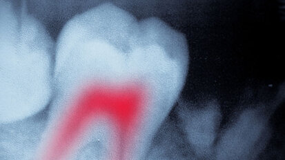 Study reveals that post-endo pain has different sources