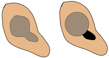 Canal anatomy as it relates to effective instrumentation and obturation
