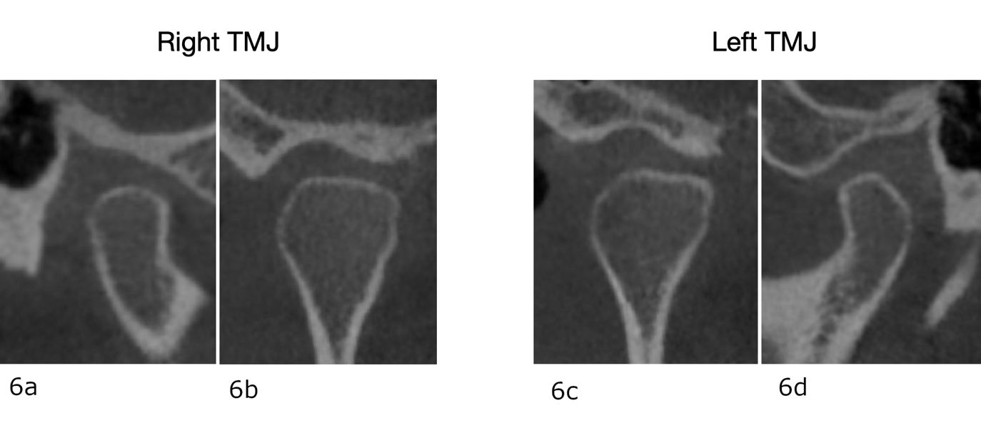 Figs. 6a–d: CBCT images showing the instability of both temporomandibular joints. Right, (a) sagittal and (b) coronal views. Left, (c) coronal and (d) sagittal views.
