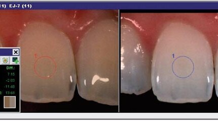 Tooth whitening: A conservative approach