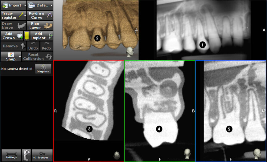 Fig. 3: The screen is divided into (1) panoramic view, (2) 3D reconstruction, (3) axial view, and (4) buccolingual and (5) mesiodistal section views.