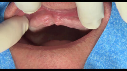 Nobel Biocare - All-on-4 treatment concept clinical case: surgical procedure & denture conversion