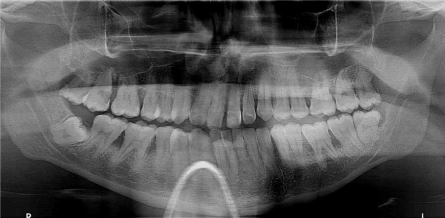 Fig. 2a: Patient detected with aggressive peridontitis in 2016.
