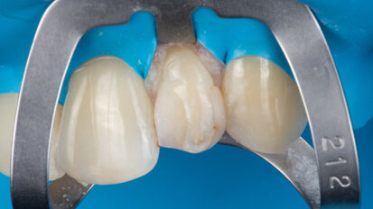 Restoring a peg-shaped lateral incisor with universal composite