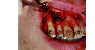 Interdisciplinary approach to treatment of maxillary radicular cysts: Minimization of surgical invasiveness and medication load