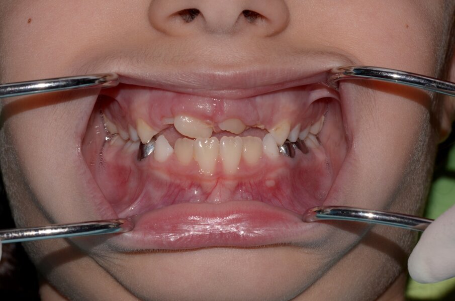 Fig. 12. One week post surgery.  Tooth 21 had begun to erupt into a crossbite after the removal of the $. Note that 11 is already in cross bite.