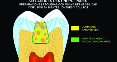 Metodología del sellado dentinopulpar (Segunda parte)