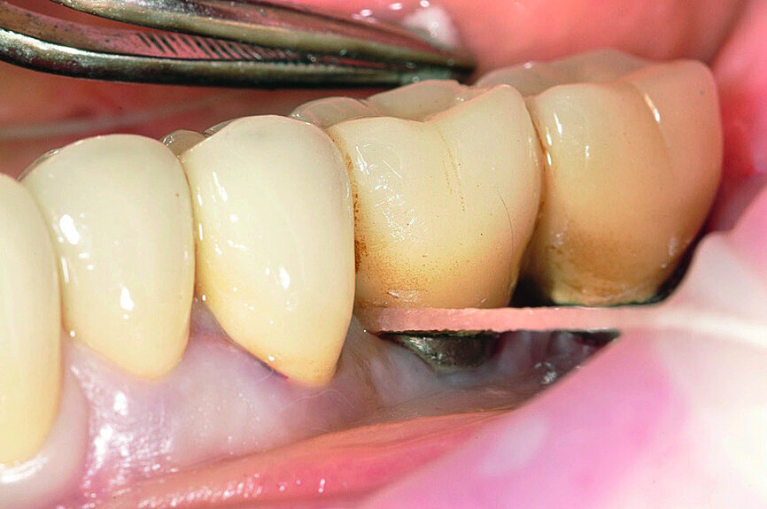 Fig. 8: Careful removal of excess cement with dental floss after prosthesis cementation.