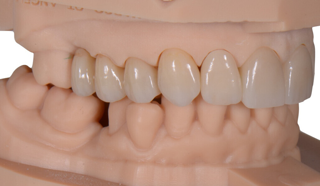Fig. 17: Lateral view showing the bridge and the anterior crowns in the first quadrant.