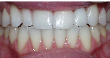 Solving esthetic dilemmas with direct composite bonding