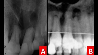 Tratamiento endoquirúrgico de periodontitis apical crónica y dientes supernumerarios