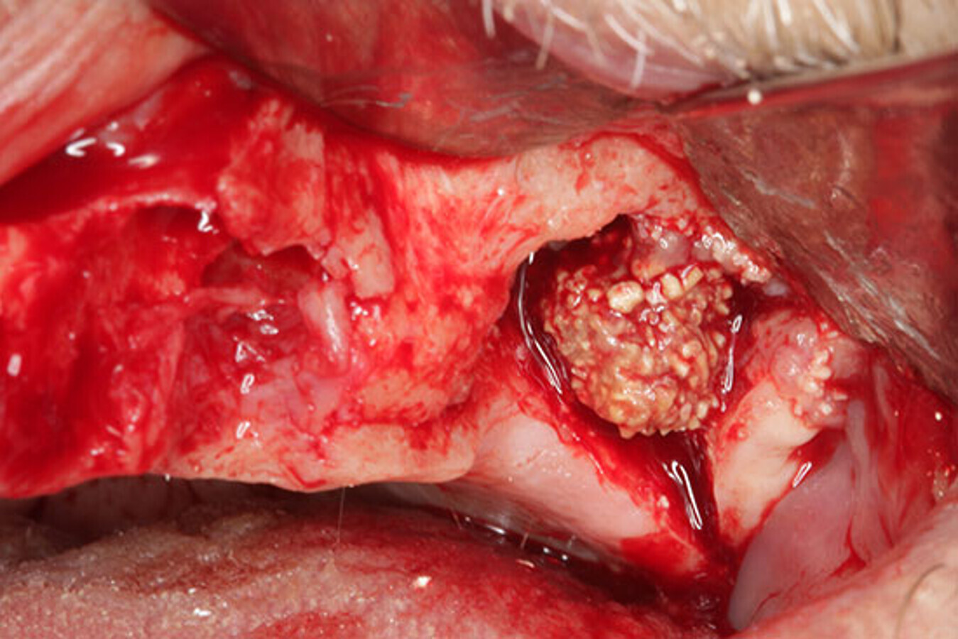 8. ElevaciÃ³n de colgajo a espesor completo. ObsÃ©rvese el material de injerto infectado. 