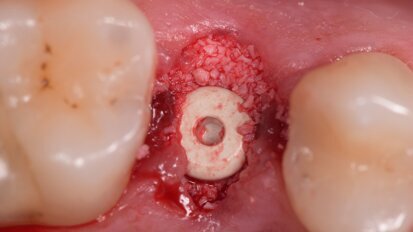 Impianto bifasico in Zirconia – Globale Restauro Metal-Free