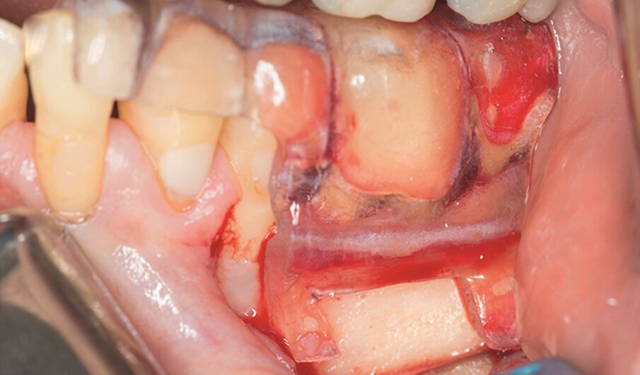 Fig. 1e–i: During microsurgery, the template was adjusted (e), …
