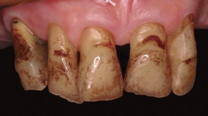 Estética y blanqueamiento dental en la era digital  (Capítulo 2)