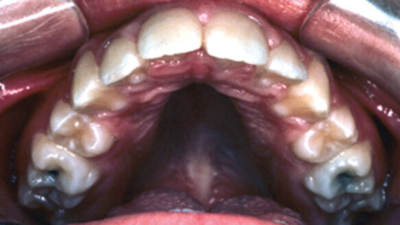 An interview with orthodontic appliance inventor Earl O. Bergersen
