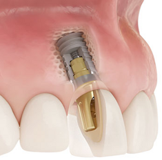Xive - implants