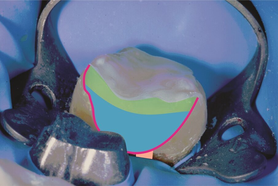 Fig. 6: Two-step universal bonding system (G2-BOND Universal; pink), fibre-reinforced composite (everX Flow; blue) and composite (Essentia; green).