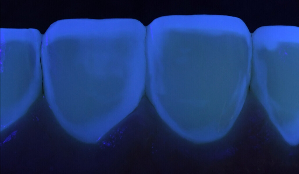 Fig. 2: Controlling structure removal with ultraviolet light, which nicely reveals the old composite.
